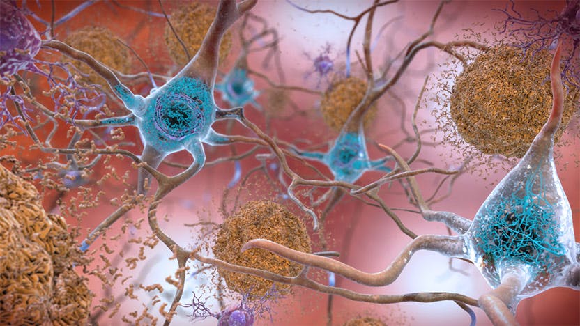 Beta amyloid plaques in the brain