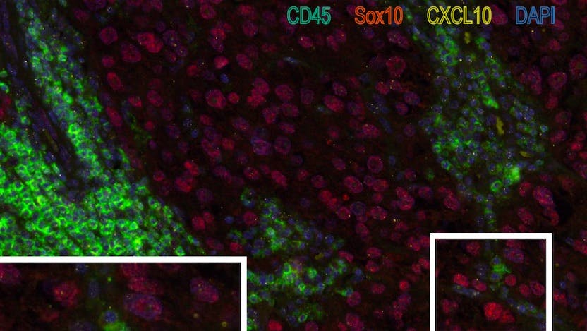 Example image of a biopsy (at the cellular level) with fluorescence labeling.  Green represents immune cells. Red represents melanoma cells. Small yellow dots indicate RNA molecules of CXCL10. Blue represents the cell nucleus. A higher magnification view is shown at the bottom-left.     Image adapted from:  Reschke R, Yu J, Flood BA, et al. Immune cell and tumor cell-derived CXCL10 is indicative of immunotherapy response in metastatic melanoma. Journal for ImmunoTherapy of Cancer 2021;9:e003521. doi: 10.1136/jitc-2021-003521