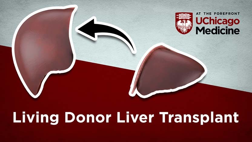 Liver donor liver transplant infographic